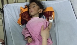 Bé gái 14 tháng tuổi chỉ nặng 3,5kg vì đói lâu ngày ở SaPa